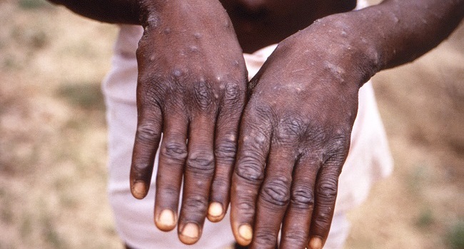 TheBiafraStar's tweet photo. New post (Due to racism, WHO renames the monkeypox disease as "Mpox") has been published on The Biafra Star - https://t.co/FsOkP76tHr https://t.co/XHxKAQQg0q