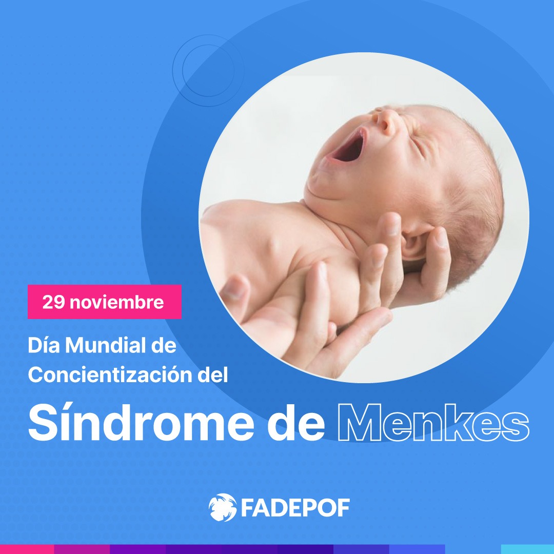 El Síndrome de Menkes es una enfermedad hereditaria en la cual el cuerpo tiene problemas para absorber el cobre. Afecta el desarrollo tanto mental como físico.
#Menkes
#concientizacion
#comunidadfadepof