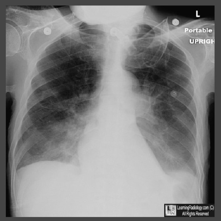 62 year-old bedridden patient with stroke and new cough. What's the most likely diagnosis?