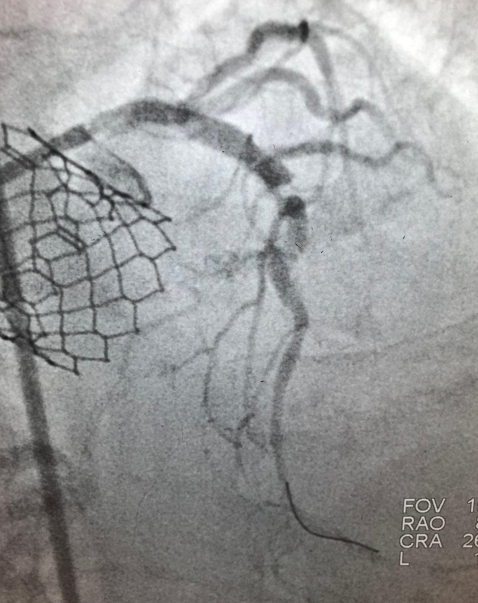 BSCCardiology's tweet image. Check out the before and after images of this HD #IVUS guided #RotaShock PCI to optimize deployment of a 3.00x38mm SYNERGY XD. Congrats to @DoctorMoussa of @VirtuaHealth on successfully opening this heavily calcified LAD, making for a great #ComplexPCI case!