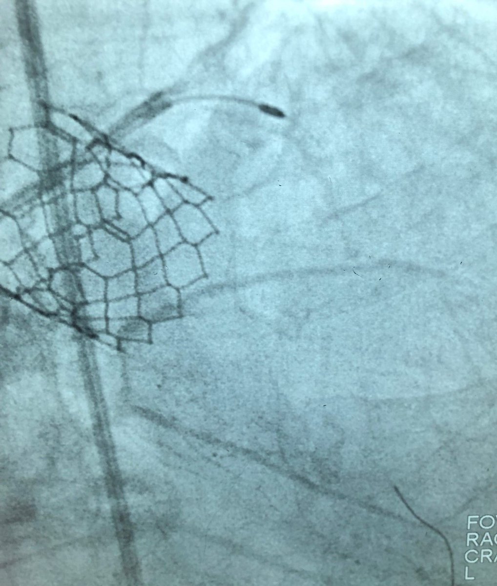 BSCCardiology's tweet image. Check out the before and after images of this HD #IVUS guided #RotaShock PCI to optimize deployment of a 3.00x38mm SYNERGY XD. Congrats to @DoctorMoussa of @VirtuaHealth on successfully opening this heavily calcified LAD, making for a great #ComplexPCI case!