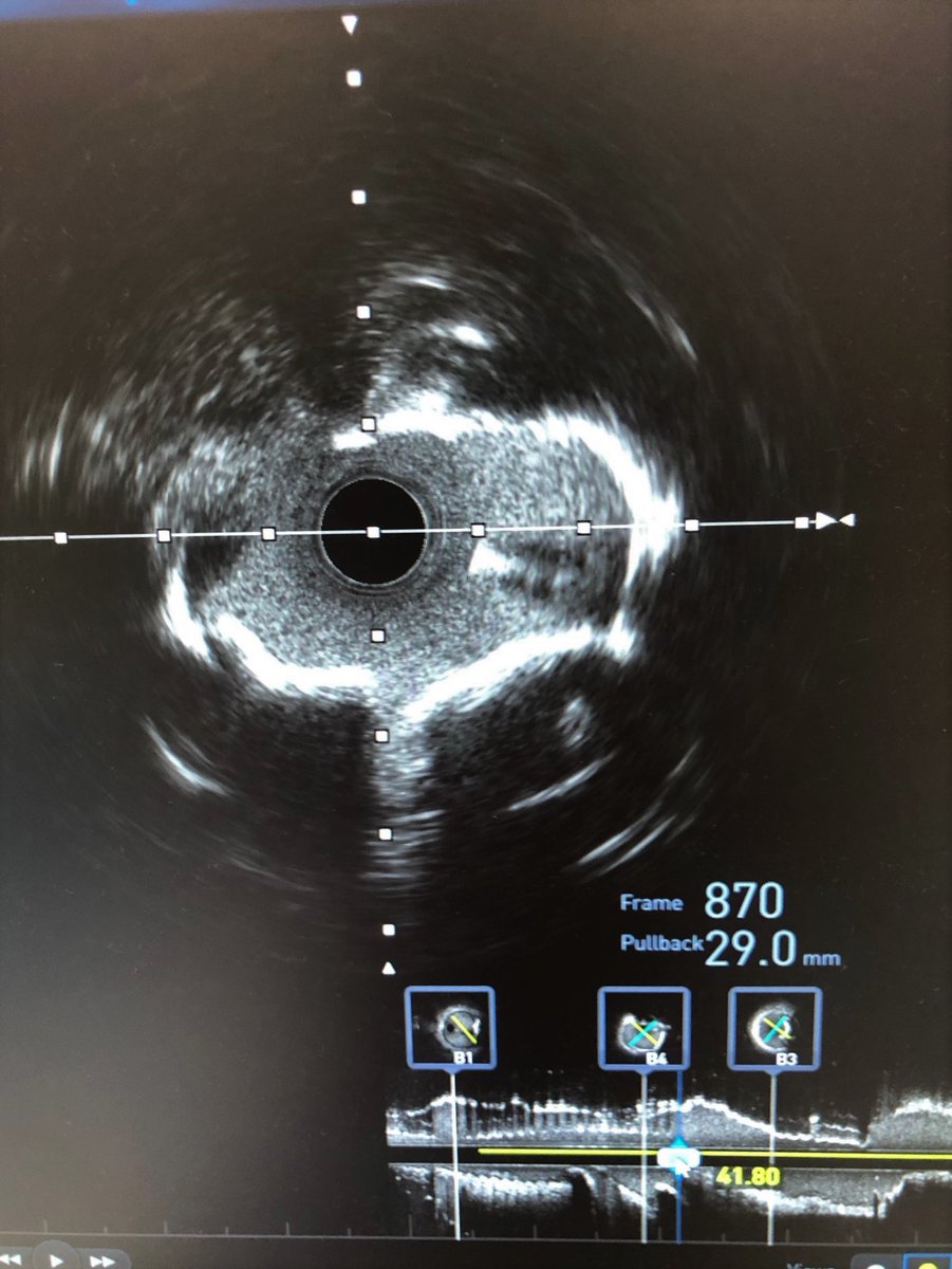 BSCCardiology's tweet image. Check out the before and after images of this HD #IVUS guided #RotaShock PCI to optimize deployment of a 3.00x38mm SYNERGY XD. Congrats to @DoctorMoussa of @VirtuaHealth on successfully opening this heavily calcified LAD, making for a great #ComplexPCI case!