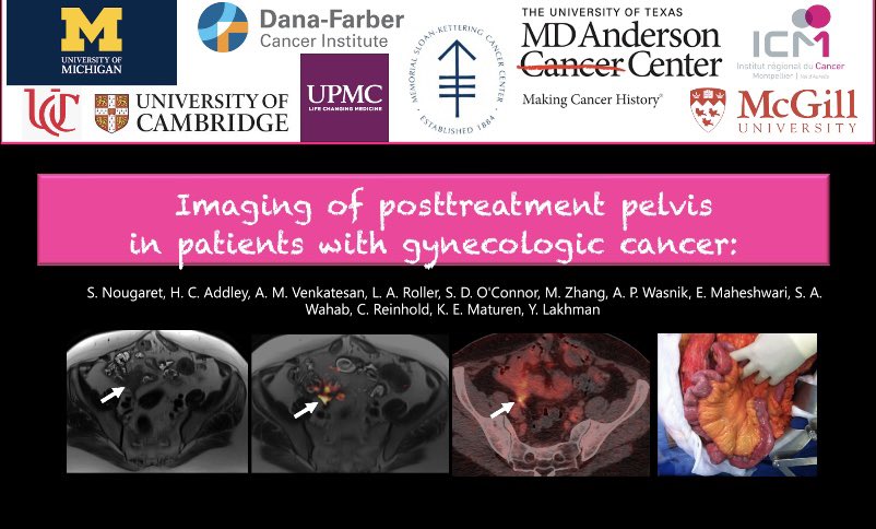 Congrats to lead author, Stephanie Nougaret MD PhD & all our coathors on our #RSNA22 Exhibit, Imaging of the post treatment pelvis in patients with gynecologic cancer (OBEE-19). #EndCancer #WomensHealth @SARpelvicDFPs