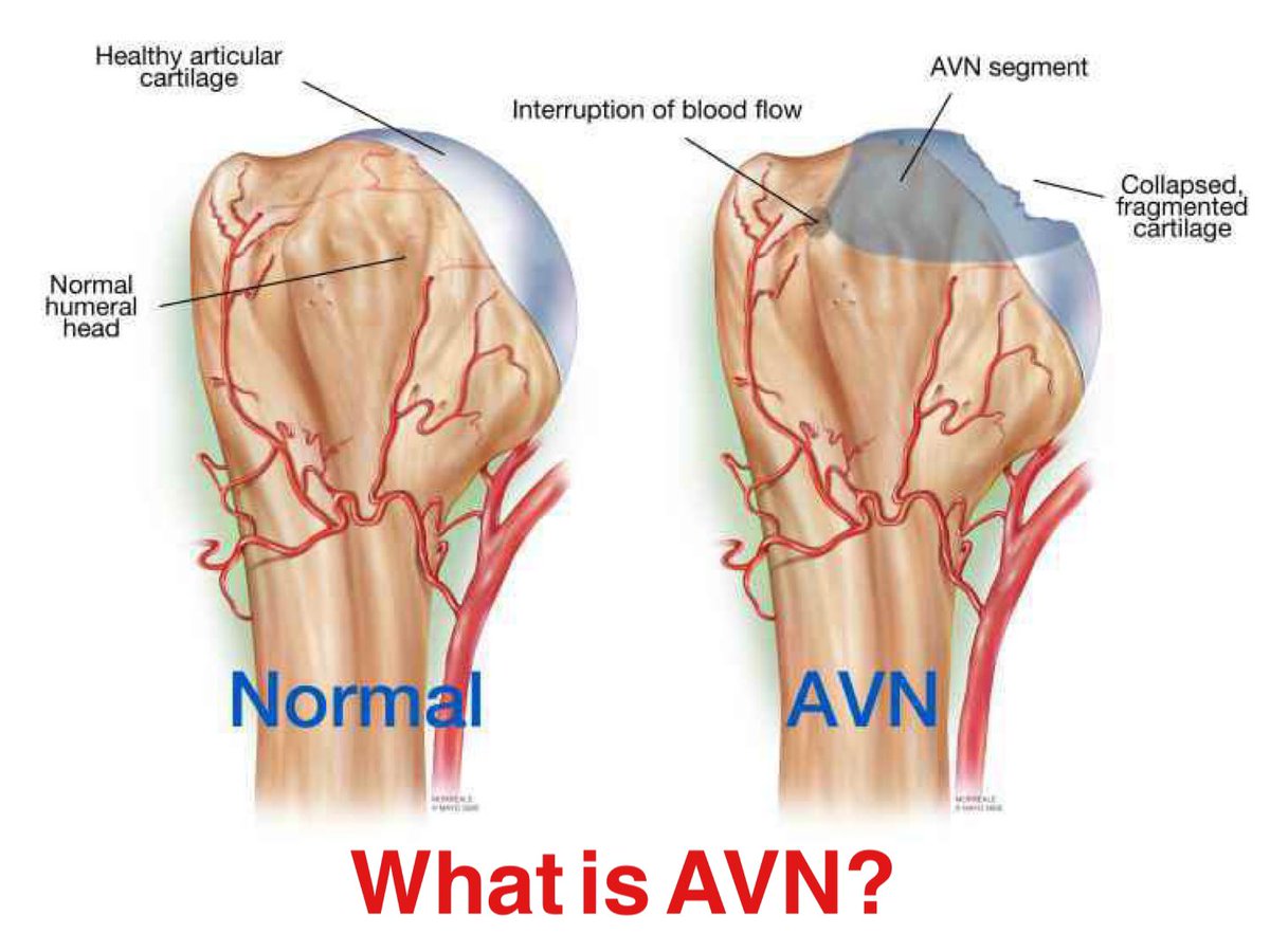 Today is Avascular Necrosis awareness day.. please retweet help spread the awareness❤️🦴 #avn #avascularnecrosis