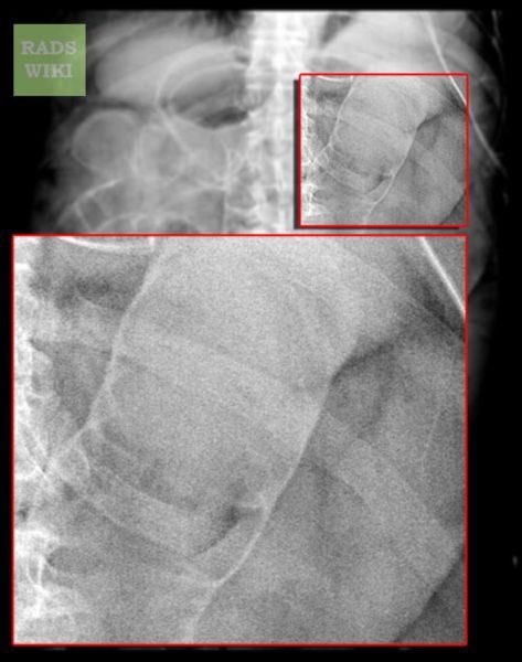 What is this classic #radiology sign indicating on this plain film of the abdomen?  #MedEd #medtwitter #radtwitter #radiology #imaging #radres #RSNA2022 #rsna22