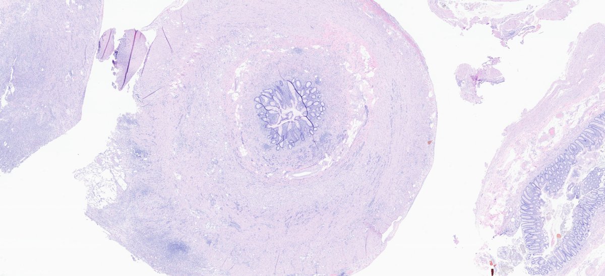 HamzaAshmila's tweet photo. Appendix: Clinically was acute appendicitis but pathologists have something else to say!!😉Answer: comment 👇 https://t.co/0AWTENIsap https://t.co/Vu4B8W21f3