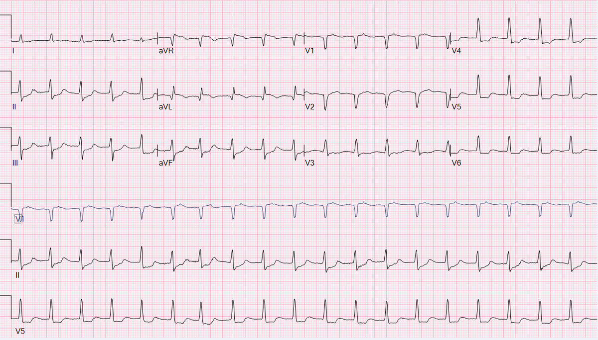 AdamGepner's tweet photo. #ECG rounds! 
73 yo M with an NSTEMI! 😟🫀
 What's the Rhythm #EPeeps? #pwaves
@a_waqar122 @DrFiveCent @AdiSCVM @RJRachwan @NagaDharmavaram @ColinNeillMD @callmeEsmaeeli @FurqanRajput @uw_cvm https://t.co/HgTogCo5ip