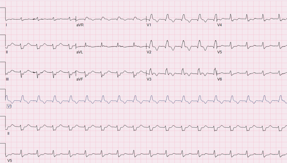 AdamGepner's tweet photo. Follow up ECG...  🤔 https://t.co/6LsUEhN3QV