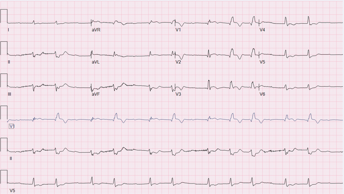 AdamGepner's tweet photo. 3rd ECG...#CardioTwitter #MedEd https://t.co/DYKpMK1wVp