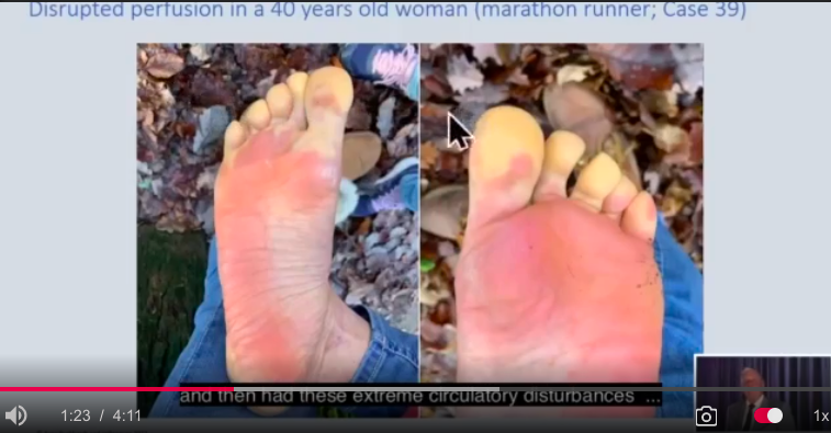 ssayssayssay's tweet photo. ๐๏ธ Like the Weather ๐ฆถ
Dr. Arne Burkhardt examined the fibrin clots pulled from a previously healthy๐marathon runner who is now disabled by tissue ischemia in her toes. > https://t.co/pmgjTCSbdY