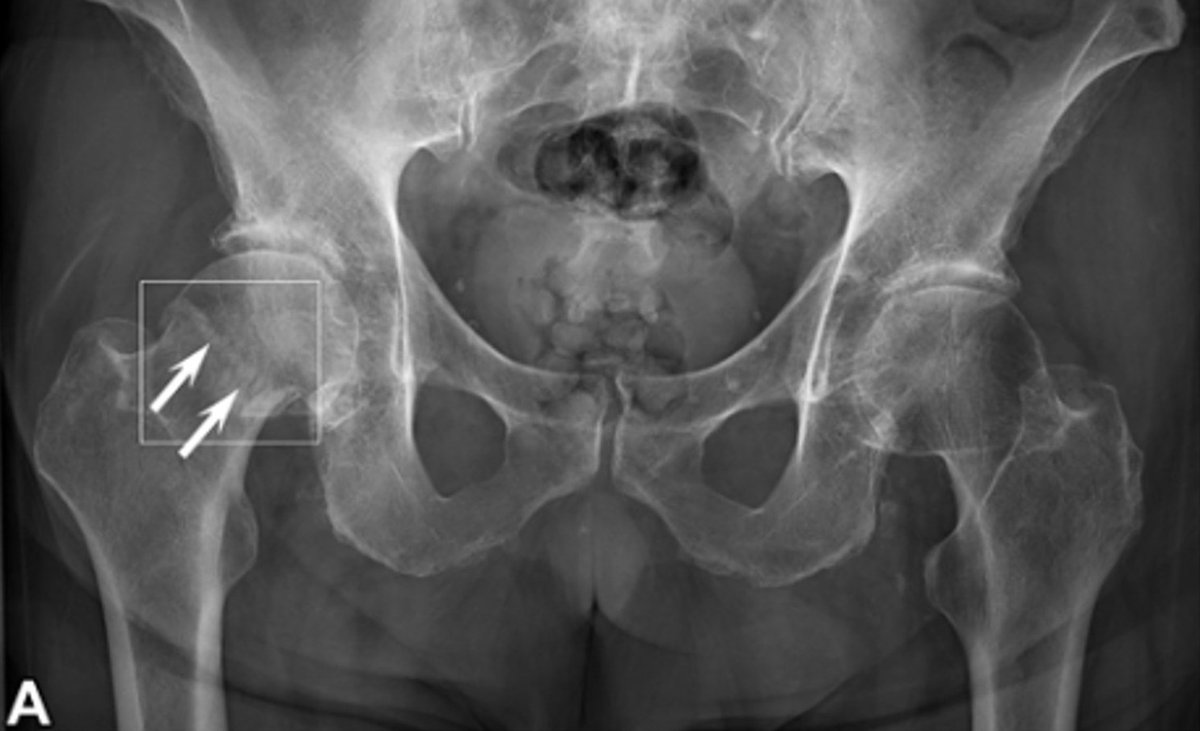 PeterCoffaro's tweet photo. #Study of GLEAMER #ArtificialIntelligence Software Wins #RSNA22 Alexander R. Margulis Award for Scientific Excellence
https://t.co/9ySMxxWifU
#AI #BoneView #DigitalHealth #fractures #healthcare #MedicalTechnology #orthopedics #orthopaedics #radiology #trauma @gleamer_ai https://t.co/WbQNadNGEo