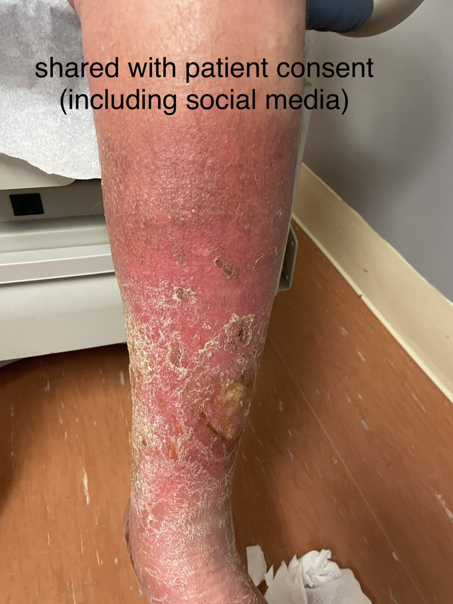 sebpoule's tweet photo. Is this cellulitis #IDtwitter ?
1/3 

(photo shared with patient consent) https://t.co/bdfvU0HE7O