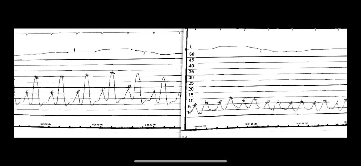 This is the best moment during #MitraClip case when you drop the grippers tighten the clip, watch the jet of MR slowly disappearing and while getting invasive LAP significantly shrinking.. Thanks to the amazing 4th generation XTW device!