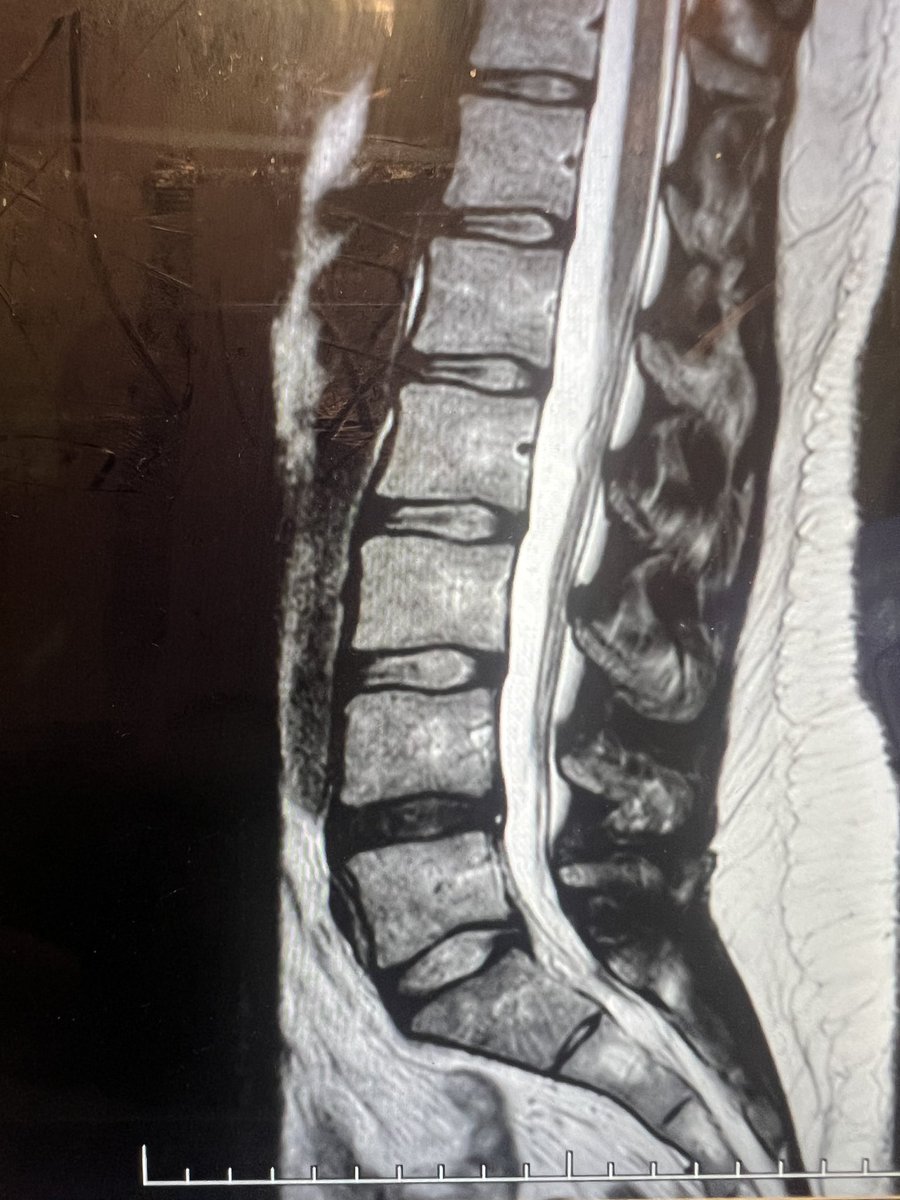 Do you fuse for a black disc and severe back pain refractory to medication, physio, exercise, weight loss and injections? Choice of fusion technique?