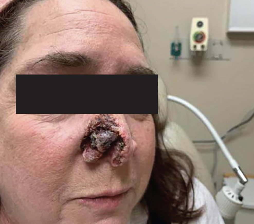 Practical_Derm's tweet photo. Basosquamous carcinoma (BSC) currently represents approx. 2% of all non-melanoma skin malignancies. The majority of cases are found in the head & neck region with predilection for Caucasian males. Herein, authors report 4 cases of #basosquamous #carcinoma. https://t.co/bywnXXxejN https://t.co/K6e2vqPCP1
