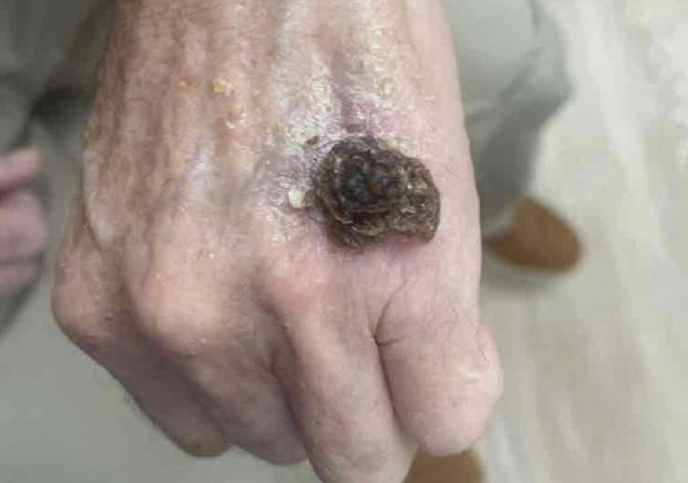 Practical_Derm's tweet photo. Basosquamous carcinoma (BSC) currently represents approx. 2% of all non-melanoma skin malignancies. The majority of cases are found in the head & neck region with predilection for Caucasian males. Herein, authors report 4 cases of #basosquamous #carcinoma. https://t.co/bywnXXxejN https://t.co/K6e2vqPCP1