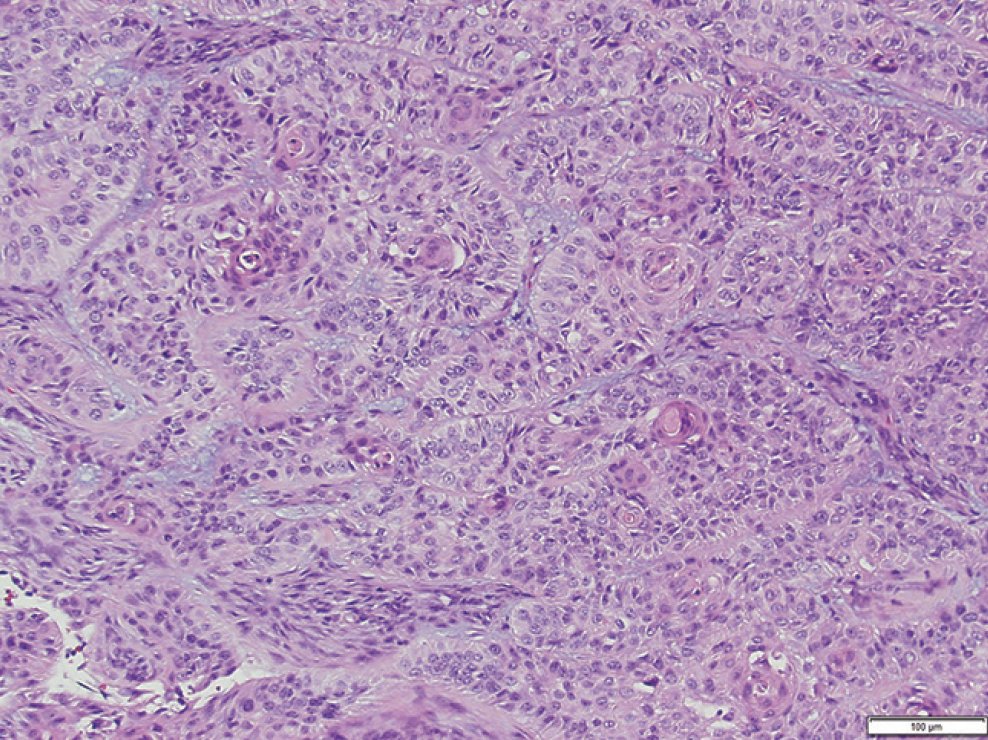 Practical_Derm's tweet photo. Basosquamous carcinoma (BSC) currently represents approx. 2% of all non-melanoma skin malignancies. The majority of cases are found in the head & neck region with predilection for Caucasian males. Herein, authors report 4 cases of #basosquamous #carcinoma. https://t.co/bywnXXxejN https://t.co/K6e2vqPCP1