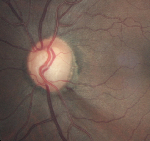 revoptom's tweet photo. Glaucoma Detectable 10 Years Prior to Its Clinical Manifestations
Study authors envision a process for more routine early screening of the general population, likely at five-year intervals.
https://t.co/KcQRDxTmqq
#retina #glaucoma #optometry https://t.co/DD46s2Jch2