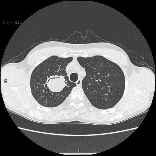 Radiopaedia's tweet photo. 40yo male with cough and wheeze. What is the diagnosis and the classic imaging sign demonstrated? Case courtesy of Nicoletti D. https://t.co/LDXeJsliqo