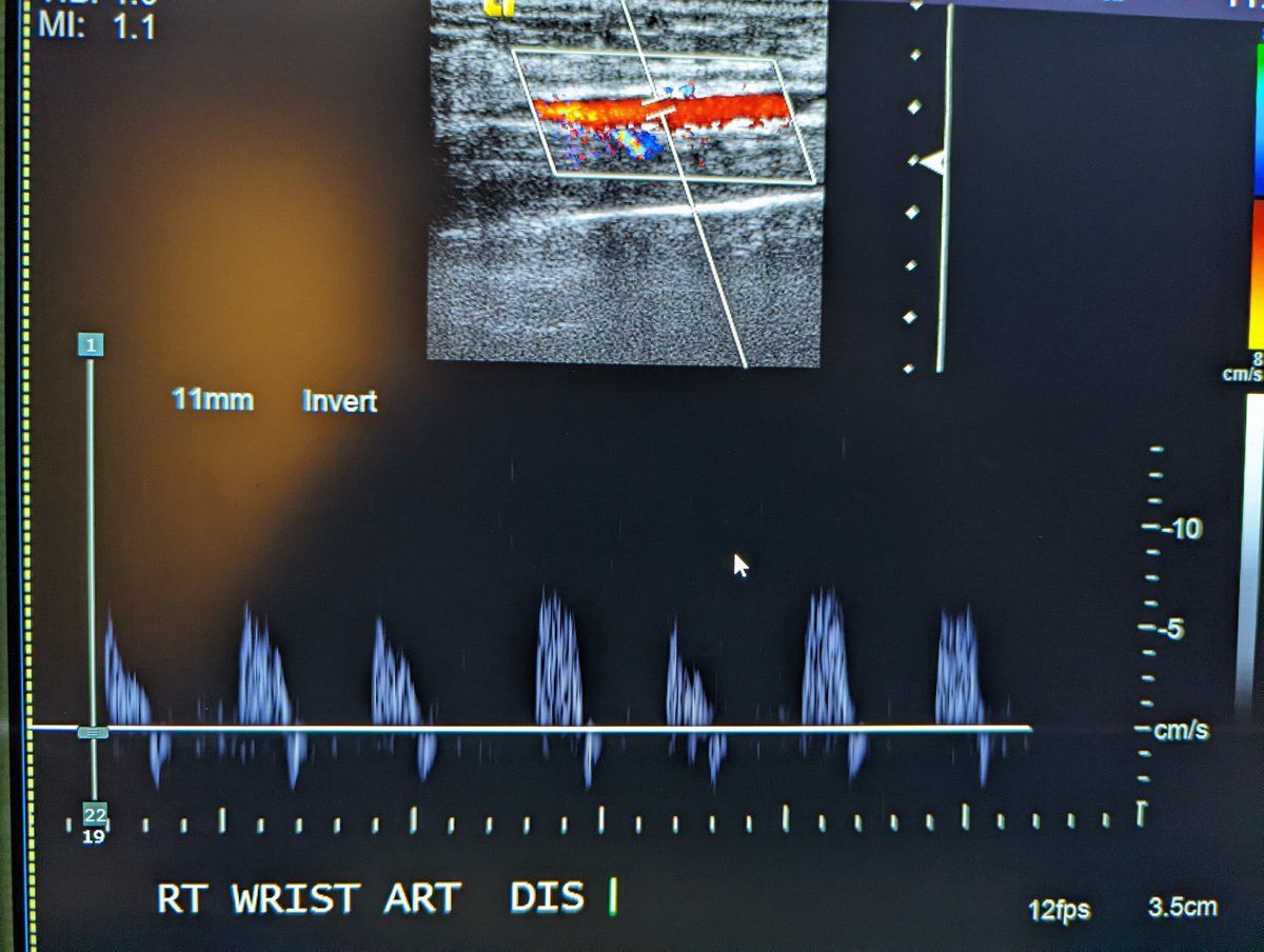 1RadDoctor's tweet photo. Ulnar artery PSA following cardiac cath. 75 units thrombin injected via 25G needle for thrombosis. Distal ulnar artery remained patent post-proc. https://t.co/kMciWs1Ee4