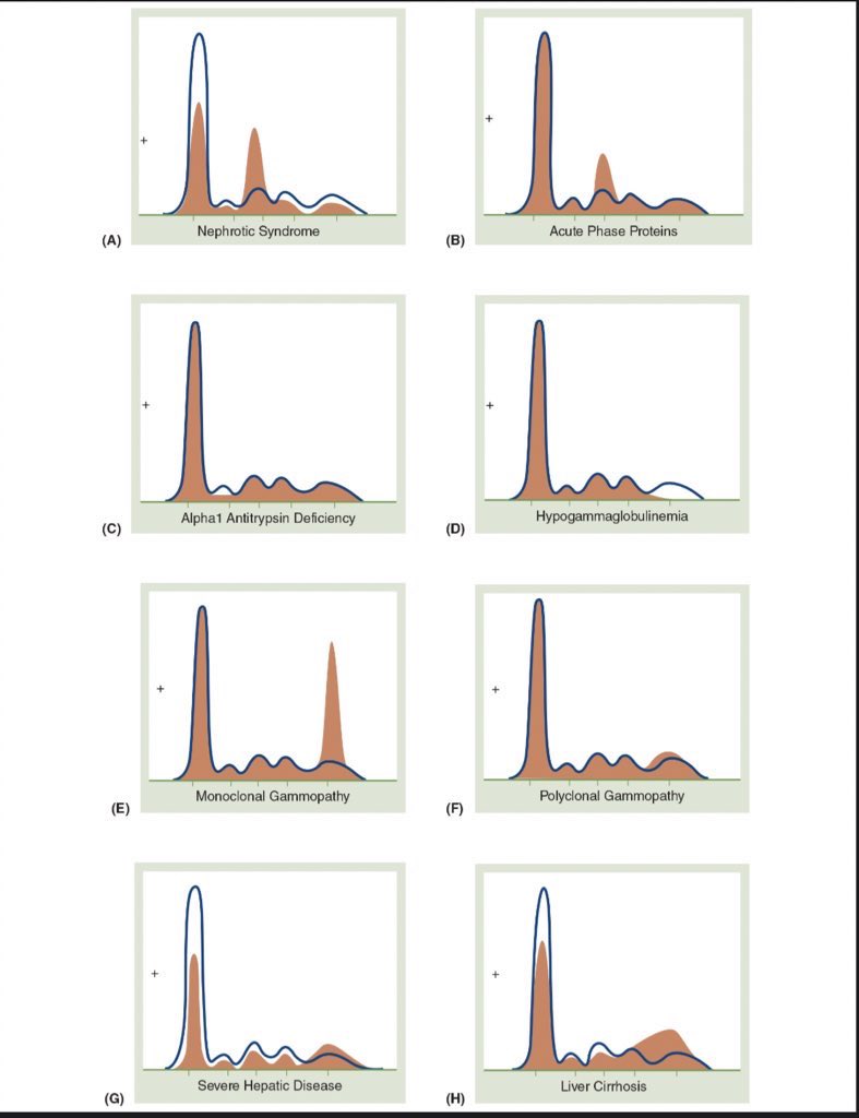 brainrotgaIore's tweet photo. 📝 CLINICAL CHEMISTRY - PROTEIN BANDS &amp; TOTAL PROTEIN ABNORMALITIES 

Five Protein Bands in Standard Electrophoresis 
✓ Albumin = most anodic
✓ α1-globulins
✓ α2-globulins
✓ β-globulins
✓ ƴ-globulins = least anodic

Reference: Bishop 9th Ed https://t.co/QmYtvxkmMm