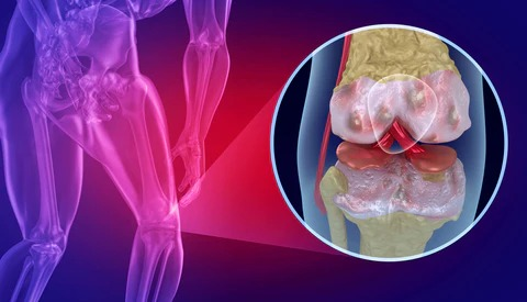 ChanonaItzel's tweet photo. ¿Sabes qué es gonartrosis?☺️🔬🩻📉
Es una enfermedad degenerativa de la rodilla, donde se presentan los siguientes puntos:
- Pérdida del cartílago articular 
- Formación de osteofitos 
- Deformación de la articulación
#Fisioterapia 
@GanteElsy https://t.co/6Gq3QSTuRK