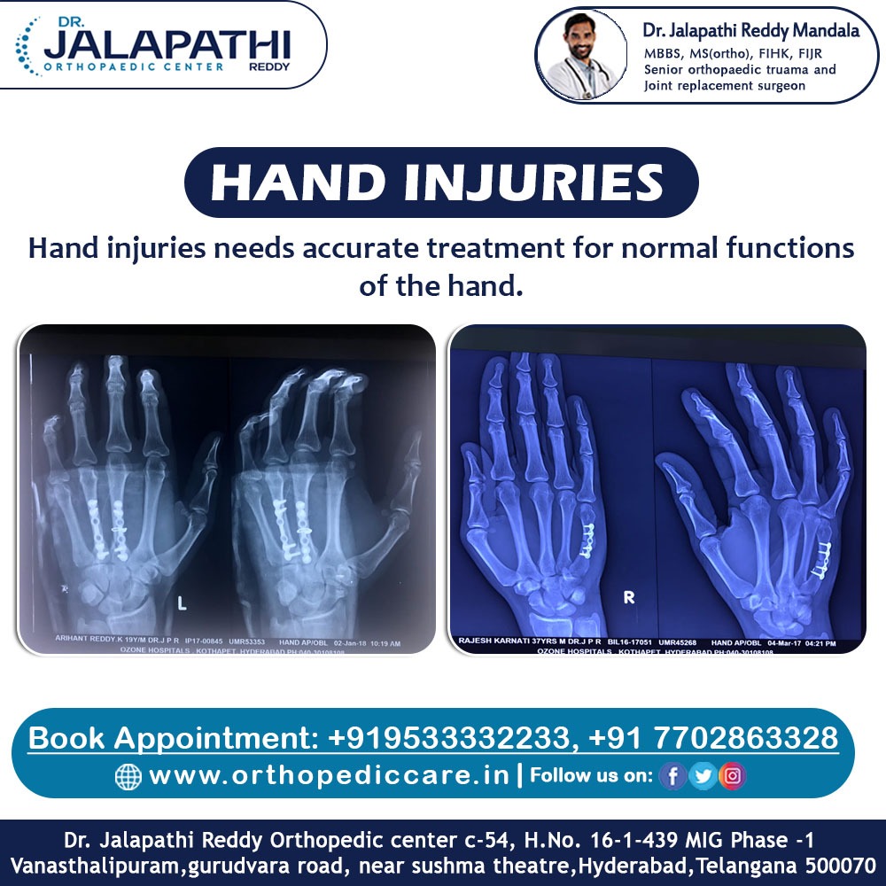 Hand injuries needs accurate treatment for normal functions of the hand

#Dr.JalapathiReddy #OrthopedicCentre #Orthopaedicdoctor #OrthopaedicSurgeon  #OrthopaedicSpecialist #orthopaedics #rheumatology #complextrauma  #handsurgeries 
orthopediccare.in