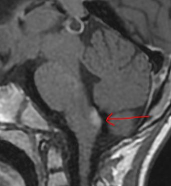 Tip of the day 💡: When there is an enhancing brain stem lesion like this, the non-invasive differential to remember is Juvenile Alexander Disease. This child was referred for radiotherapy for a presumed brainstem tumour! How would you confirm the diagnosis?