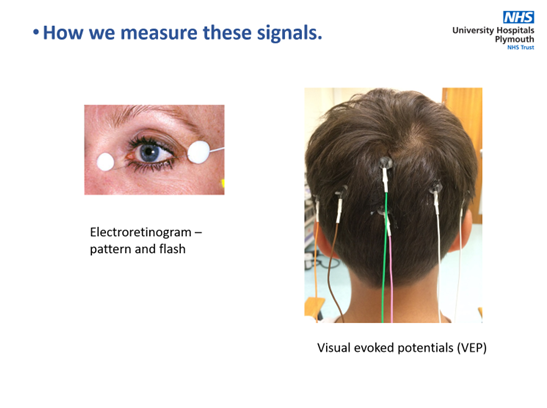 NeurophysUHP's tweet photo. @flower_georgia and @NikkiBroomfiel2 gave a talk to the REI dept at @UHP_NHS recently about how visual electrophysiology is used to localise visual pathway dysfunction.  Much more fun than it sounds..... https://t.co/MfcpDlaGP1