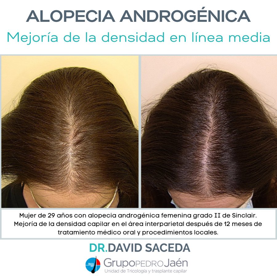 Alopecia Androgénica Femenina Premenopausica Mujeres, Pérdida de pelo, cabello, caida, Solución, problema, especialista, clínica Madrid