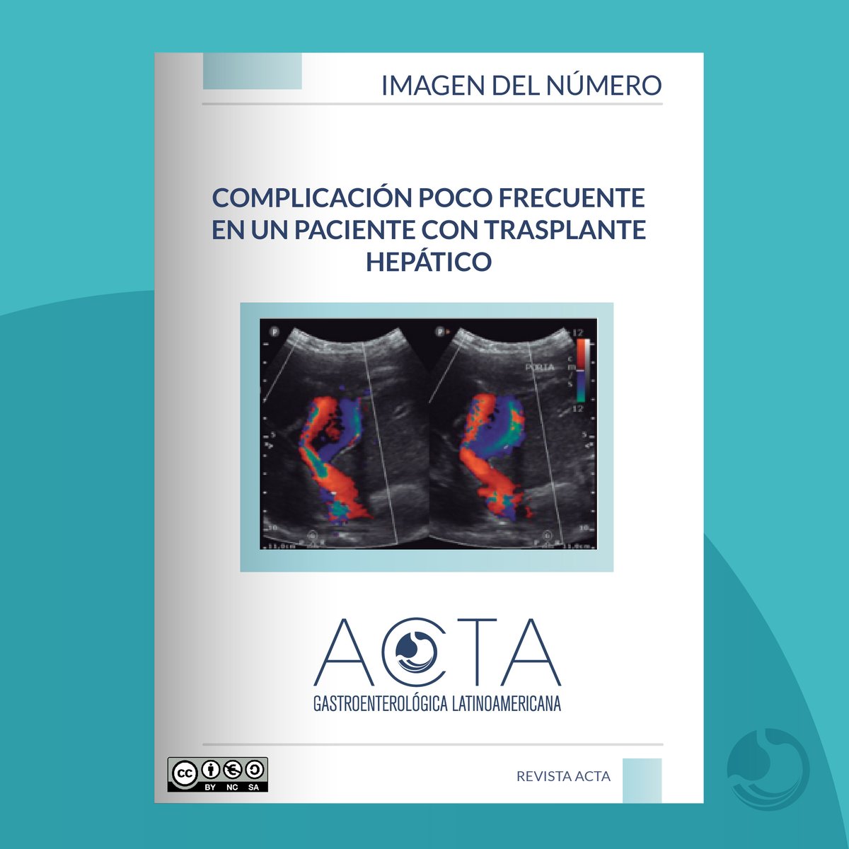 ACTA_Gastro's tweet photo. #ImagenDelNúmeroACTA
➡️ Complicación poco frecuente en un paciente con trasplante hepático⬅️

¡Contanos cuál es tu impresión diagnóstica!
👇🏽También está la resolución del caso  ❌ ¡No vale mirar antes de responder!
https://t.co/VMrBbUw9SC https://t.co/hhYf9das3J