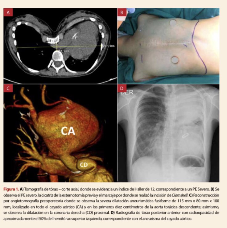 Aneurisma gigante de cayado Aórtico +Sd Marfan 🤯

➡️El Sd de Marfan suelen ir con debilidad de la pared de la Ao

➡️Si a eso le sumamos una re intervención sobre un pectus excavatum severo, como lo abordamos? 
👇🏼

👩🏽‍💻‼️Todo sobre la incisión de Clamshell 
doi.org/10.47487/apcyc…