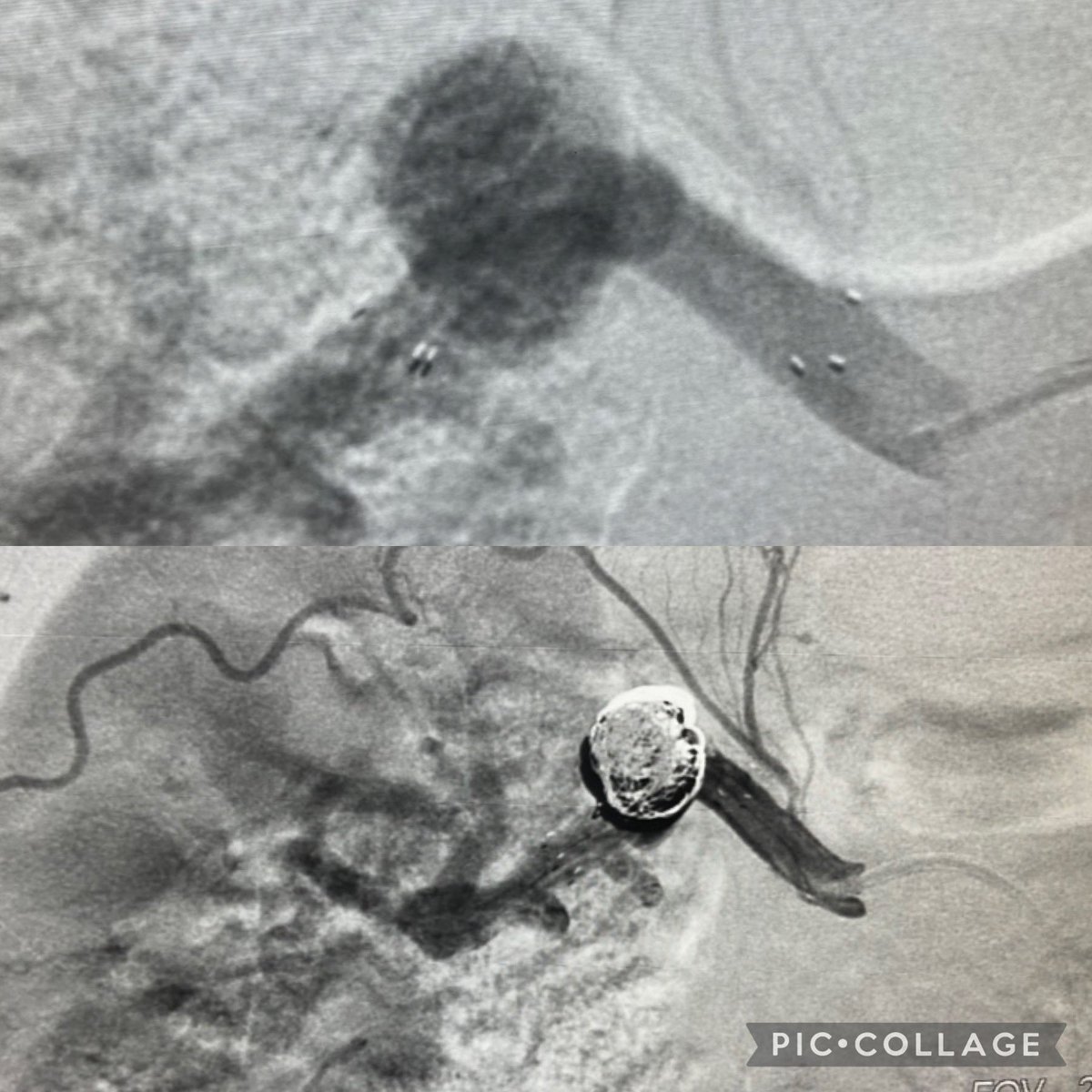 OckeReis's tweet photo. We present 3 cases of saccular renal artery aneurysms treated by embolization with coils, the third case with assisted-stent-technique.

Authorized publication.

#vascularsurgery
#embolization
#embolizations
#endovascularsurgery https://t.co/itPX3DDblz