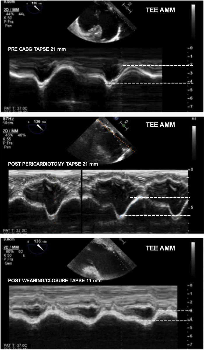 Important #POCUS #echofirst pitfall 🚨
TAPSE (tricuspid annular systolic plane excursion) reduces without reduction in RV function (RVOT VTI) in post cardiac surgery patients. 
🔗jtcvs.org/article/S0022-…
#MedEd #Nephpearls
