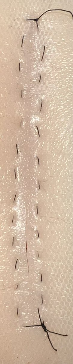 DoctorPetruzzo's tweet photo. Forgot 2 post this yesterday, but here’s my first attempt at a running horizontal mattress stitch! I definitely need to work on lining up each side and keeping both sides of the skin together without it pulling, but I’m proud of my spacing! I used 5/0 silk braided for reference:) https://t.co/TUeL1Zt2aK