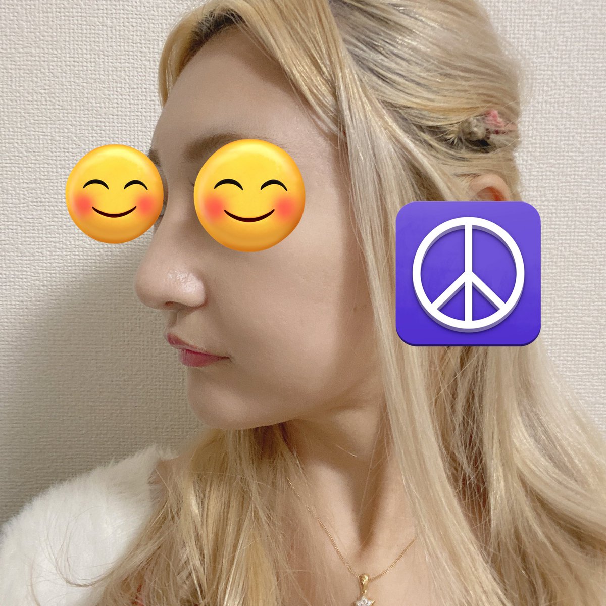 krm_hnk's tweet photo. 3ヶ月目。鼻筋よりもフェイスラインの方が変化あるかも？？ @kr_biyo_seikei https://t.co/VisUHoskBB