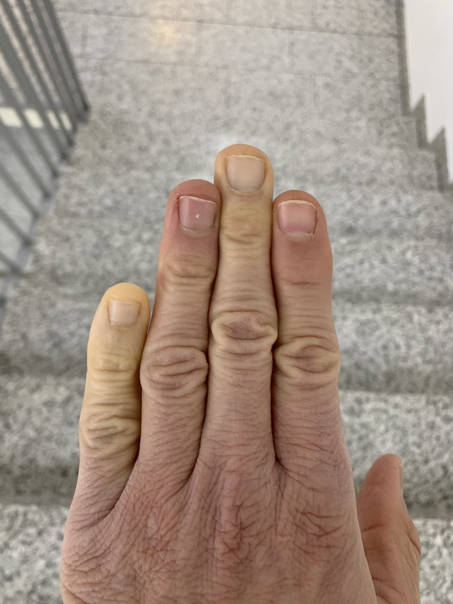 Arthrosezentrum's tweet photo. Raynaud Orthopädenedition
Der Winter ist einfach nicht meine Jahreszeit https://t.co/tdSkc2ZR2x
