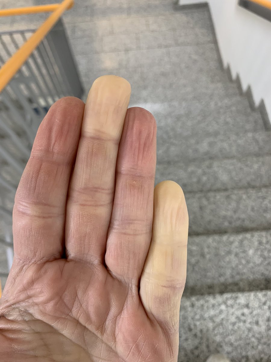 Arthrosezentrum's tweet photo. Raynaud Orthopädenedition
Der Winter ist einfach nicht meine Jahreszeit https://t.co/tdSkc2ZR2x