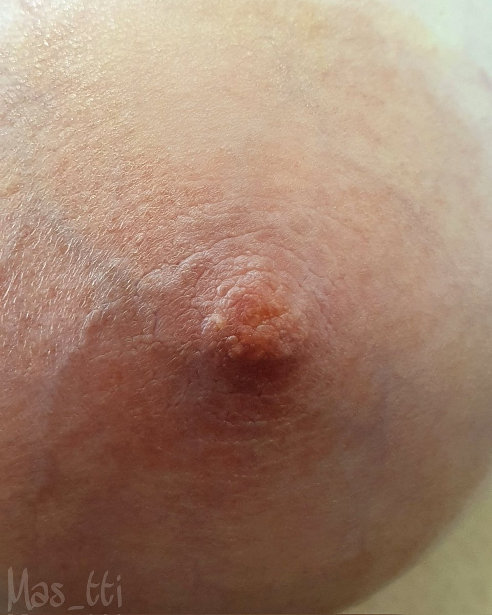 Mas_tti's tweet photo. Correzione capezzolo piatto
#freethenippple #piercing #mas_tti https://t.co/2nY3kD84Xf