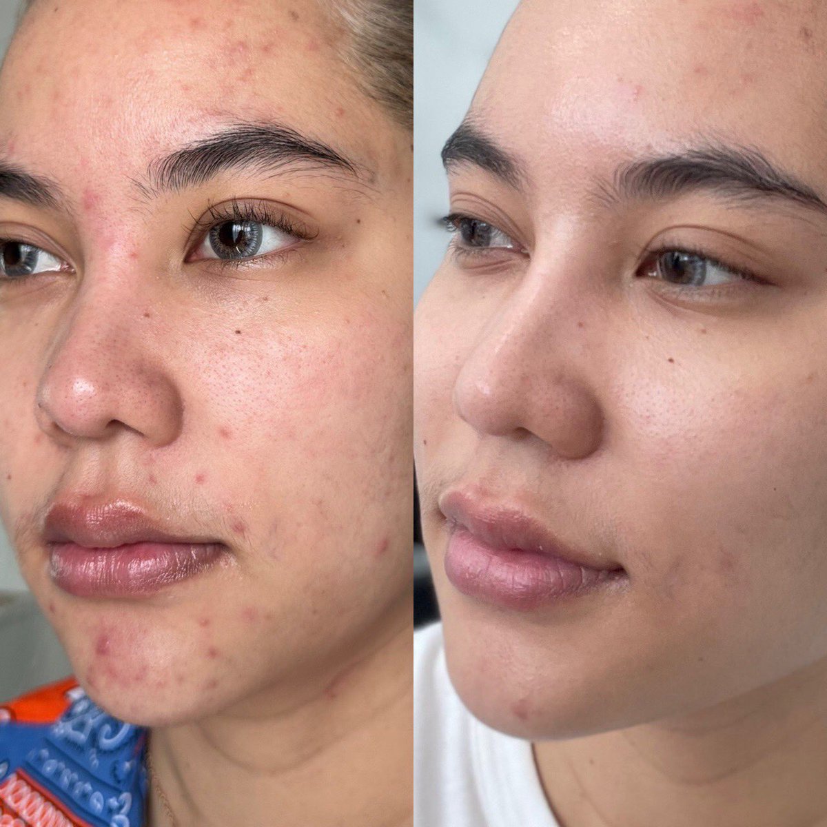 mimilkss's tweet photo. ติดใจจนอยากรีบมารีวิว เซรั่มกู้ผิวใส ฉ่ำโกล์ว ที่แท้ทรู B’Skin HYA Whitening Mulberry Booster Serum ใช้ตัวเดียวจบ ได้ทั้งผิวกระจ่างใส ฉ่ำน้ำ อิ่มฟูสุดๆ ผิวสวยตั้งแต่ครั้งแรกที่ใช้เลย ใช้ต่อเนื่องไปซักพัก ริ้วรอย สิวเล็กๆคือหายหมด โคตรฟิลดี กลายเป็นเซรั่มที่ขาดไ��่ได้ไปเลย https://t.co/zeGfd7lPTr