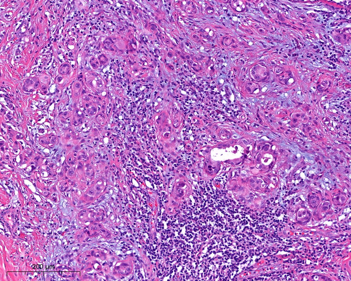 A. Polónia (@poloniaantonio) on Twitter photo What an amazing case! Please see all the photos (HE and HER2) before answering to the poll😃 #breastpath <a href="/atman_ci/">Dr. Luca</a> <a href="/ADamronMD/">Alexander Damron, MD</a> <a href="/LizaMQuintana/">Liza Quintana, MD</a> <a href="/AGrabenstetter/">Anne Grabenstetter</a> <a href="/DrGeeONE/">Olaleke Folaranmi</a> <a href="/tlabiano/">Tania Labiano</a> <a href="/AmPathology/">Ana Marques</a> <a href="/jennpincus/">Jenny Pincus, MD</a> <a href="/ariella8/">Celina Stayerman MD</a> <a href="/nusrat_xahra/">🔻Nusrat Zahra🔻🇵🇸</a> @miss_me1986 <a href="/gonzadetoro/">Gonzalo De Toro</a> <a href="/TristanRutland7/">Tristan Rutland MBBS FRCPA IFCAP</a> <a href="/LoboAnandi/">Anandi Lobo, MD</a> What an amazing case! Please see all the photos (HE and HER2) before answering to the poll😃 #breastpath <a href="/atman_ci/">Dr. Luca</a> <a href="/ADamronMD/">Alexander Damron, MD</a> <a href="/LizaMQuintana/">Liza Quintana, MD</a> <a href="/AGrabenstetter/">Anne Grabenstetter</a> <a href="/DrGeeONE/">Olaleke Folaranmi</a> <a href="/tlabiano/">Tania Labiano</a> <a href="/AmPathology/">Ana Marques</a> <a href="/jennpincus/">Jenny Pincus, MD</a> <a href="/ariella8/">Celina Stayerman MD</a> <a href="/nusrat_xahra/">🔻Nusrat Zahra🔻🇵🇸</a> @miss_me1986 <a href="/gonzadetoro/">Gonzalo De Toro</a> <a href="/TristanRutland7/">Tristan Rutland MBBS FRCPA IFCAP</a> <a href="/LoboAnandi/">Anandi Lobo, MD</a>