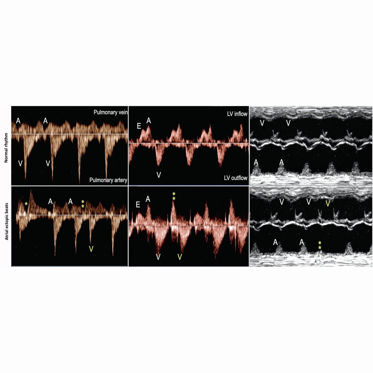 ISUOG's tweet photo. Systematic review and meta-analysis by Bet et al. published in #UOGJournal shows fetal premature atrial contractions are associated with a 4-5-fold increase in the risk of congenital heart defect compared with the general population https://t.co/Ygc6N63io8 #ISUOG @WileyHealth https://t.co/YgS2uwkdlE