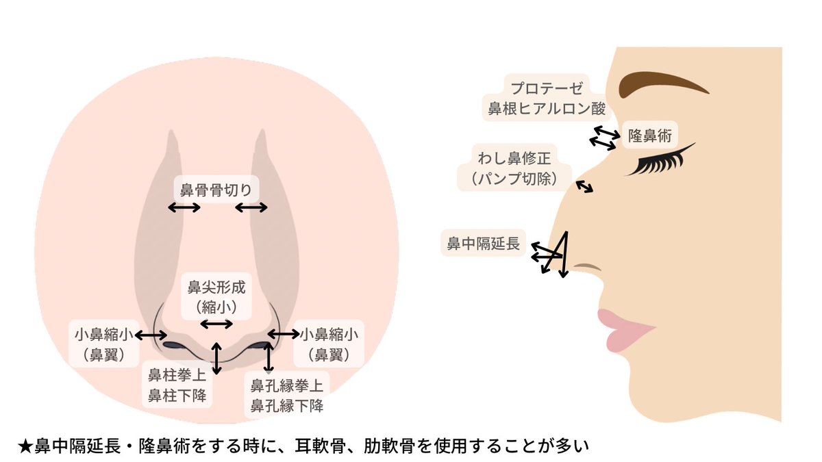 biyouiryou100's tweet photo. 【鼻整形前に絶対勉強してほしいこと】

①鼻の場所の名前と手術の種類(画像見て)
②医師の選び方(コメ欄見て)
③カウセで確認することまとめ(コメ欄見て)
③鼻中隔延長のリスク
④感染、鼻炎、変形のリスク
⑤ダウンタイムの過ごし方
⑥完成形は半年後
⑦軟骨の種類
⑧自家組織と人工物の違い https://t.co/cxc44LqBKj