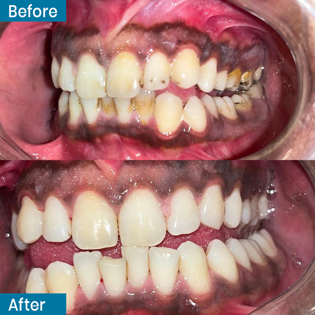 SmileCenterISB's tweet photo. Procedure: Scaling and polishing done by Dr. Salwan

Smile center Dental Clinic,
Office 37&amp; 38 Ground floor, Al-babar Center, Park Road, F-8 Markaz Islamabad.

Book your appointment through Dm or Whatsapp or Call. 😊😊
☎051-8351111
📱03317779555
📍https://t.co/WeWXo7kA3G https://t.co/gvHIndxKT4