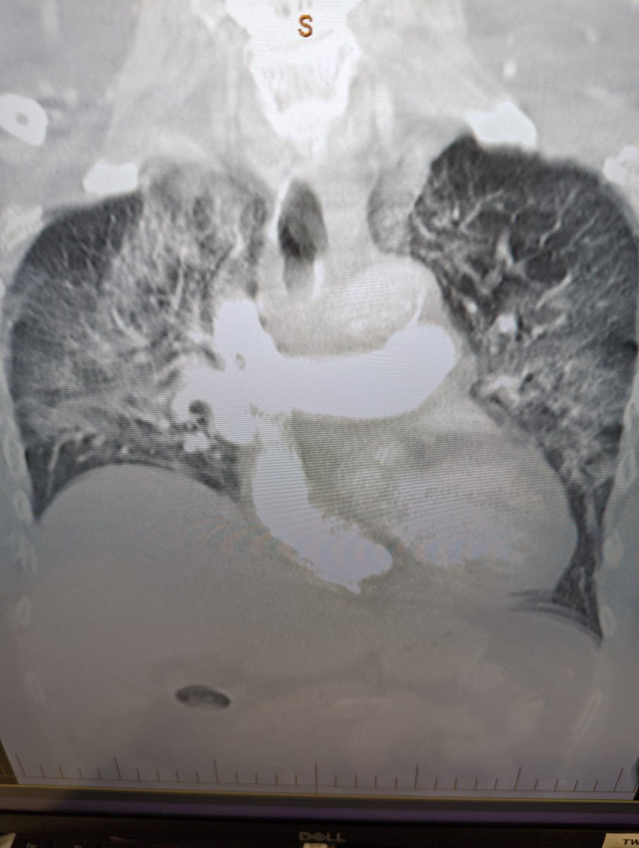 Pt with severe bilateral PUK : melted both sclera and CyA an MMF AND steroid dependent : this was Covid despite Euvasheld and five vaccines : still survived thanks to modern icu Care