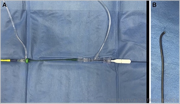 #ONSNew SOFIA Nonwire Advancement techniKE 35 Technique: A Minimalist Approach to Stroke Thrombectomy bit.ly/3FXkVzb by Colasurdo et al Padua University Hospital @CNS_Update @LKReedMD @jmascite @DKondziolkaCNS @adelawu @e_celano  
#Artery #Catheters #Reperfusion #Stroke