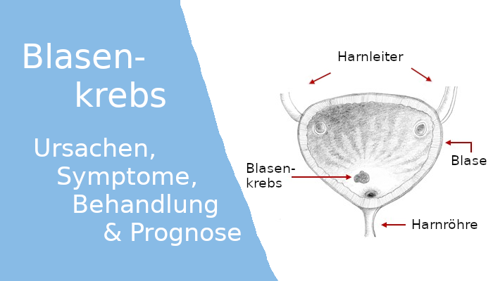 NavigatorMed's tweet photo. +++ Blasenkrebs: Ursachen, Symptome, Behandlung, Prognose +++
https://t.co/HgGybFJayD
Was verursacht Blasenkrebs? Welche Behandlungsmöglichkeiten gibt es? Ist der Tumor heilbar? Und wann muss die Blase entfernt werden? https://t.co/BX731HNMS5