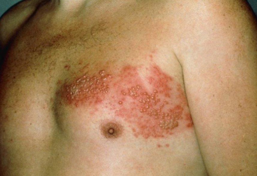A patient comes in with a painful rash in his chest area. What is the likely diagnosis? #Medtwitter