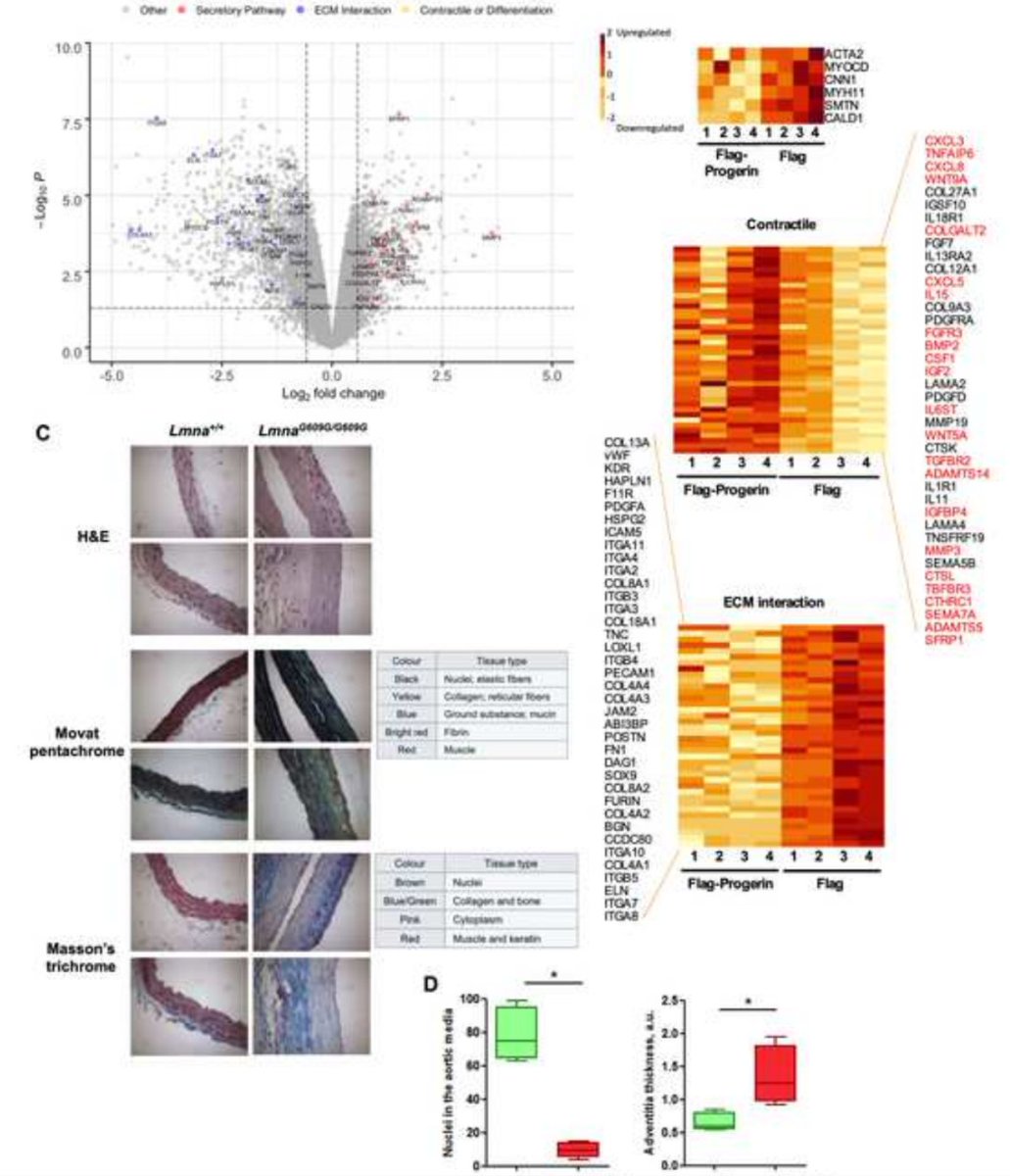 GeroScienceAGE's tweet image. 📢New Recommended Reading
#Progerin induces a phenotypic switch in vascular smooth muscle cells and triggers #replicationstress and an #aging-associated secretory signature by @CollBonfillN et al. 
link.springer.com/article/10.100…
#cardiovasculardisease
#telomerefragility