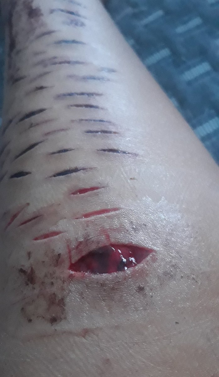 Zero28145304's tweet photo. ♤ I love how this old cut was healing♡
988twt beanstwt styrotwt yellowspongetwt shtwt https://t.co/TyWCVBrSa5